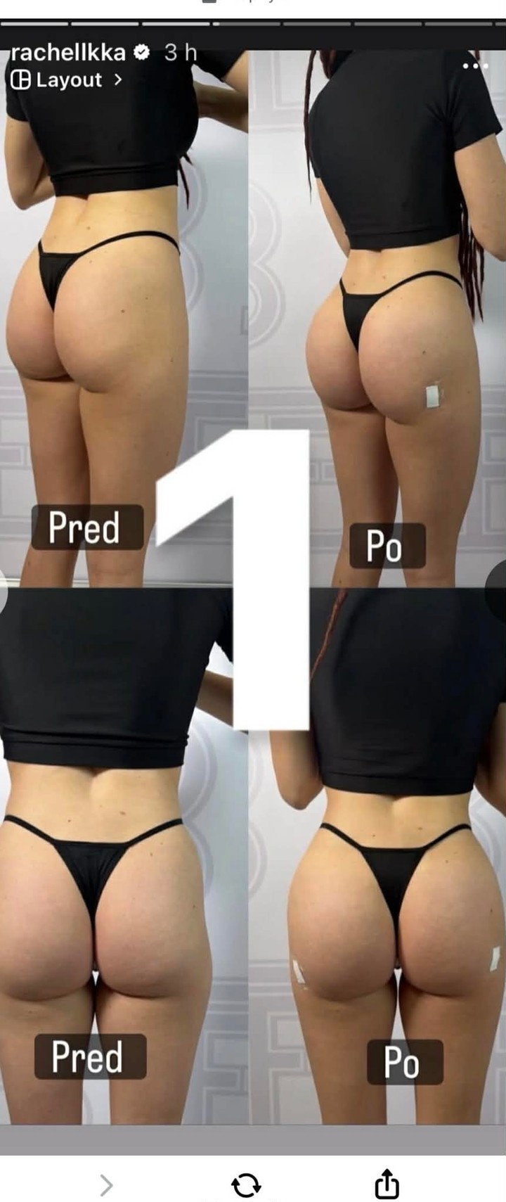 Ráchel Karnižová, Plastická operácia, Zadok